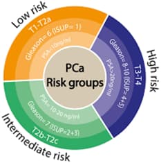 Comprender las categorías de riesgo en el cáncer de próstata