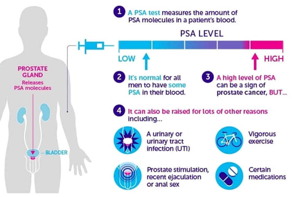 Pros and Cons of Prostate Cancer Screening