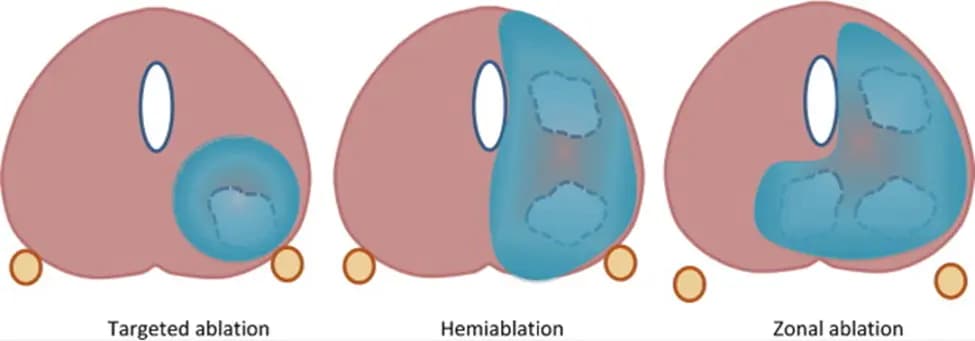 Types of Focal Therapy